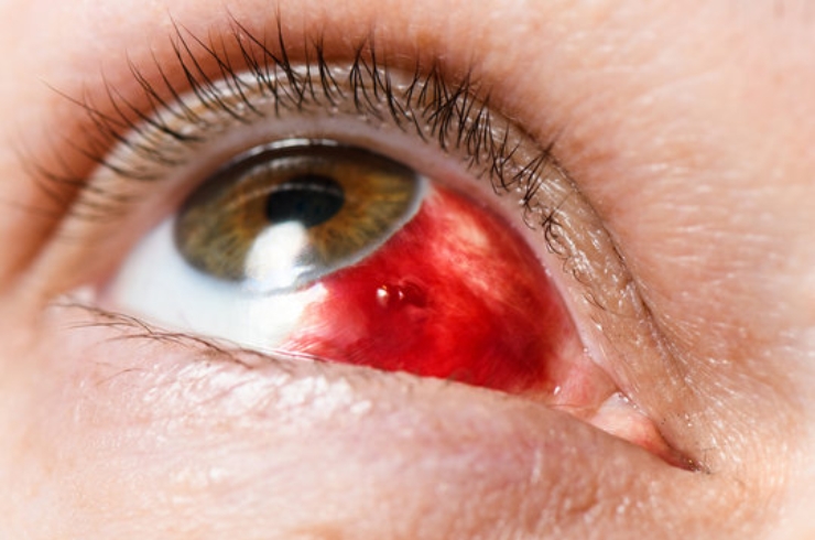 Ocular Injury Treatment------27
